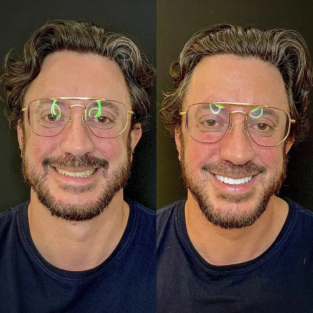 Rafael, paciente, antes e depois das lentes de contato dental